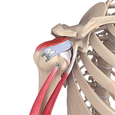 Superior Capsular Reconstruction